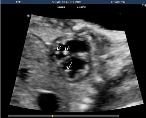 lv echogenic focus|ultrasound for echogenic focus.